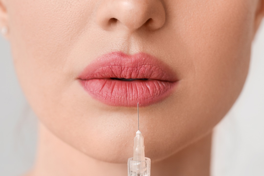Hyaluron Lippenunterspritzung bei Medaesthetics