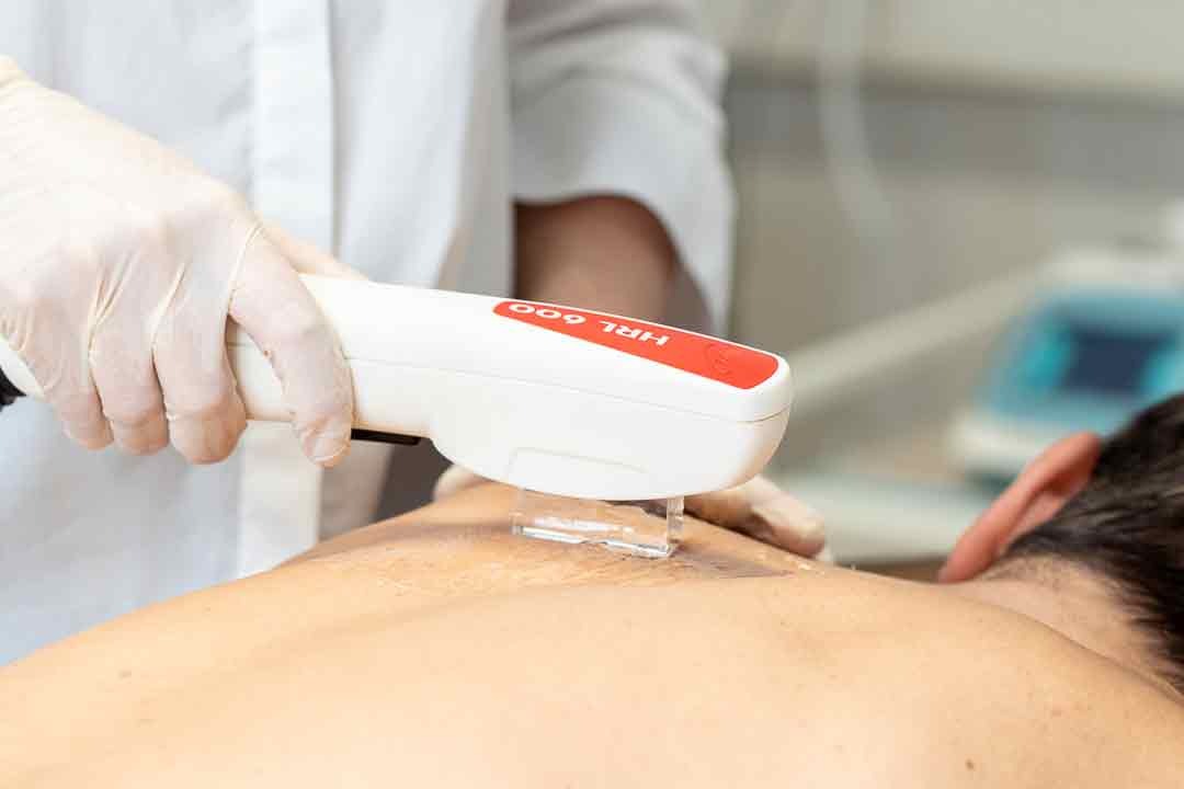 Lichtbasierte Haarentfernung bei Medaesthetics